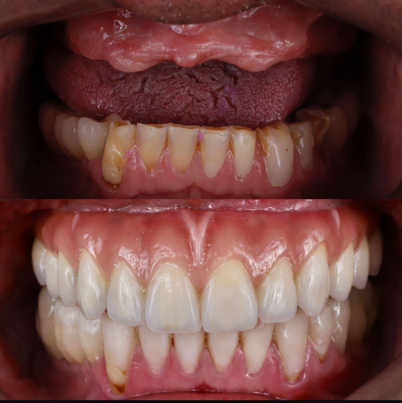 Antes e depois - Facetas Dentárias